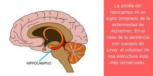 diferenciar entre la demencia con cuerpos de Lewy y la demencia debida al alzhéimer
