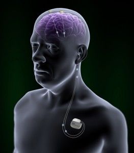 estimulación cerebral profunda para la enfermedad de Alzheimer