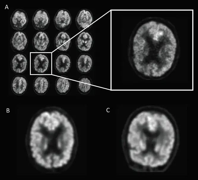 Inteligencia Artificial Y Neuroimagen Un Binomio Prometedor En La