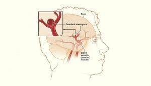 complicaciones del aneurisma cerebral