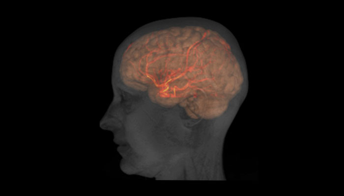 flujo sanguíneo cerebral alzheimer