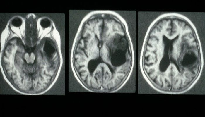 Glioma en el cerebro síntomas