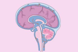 edema cerebral