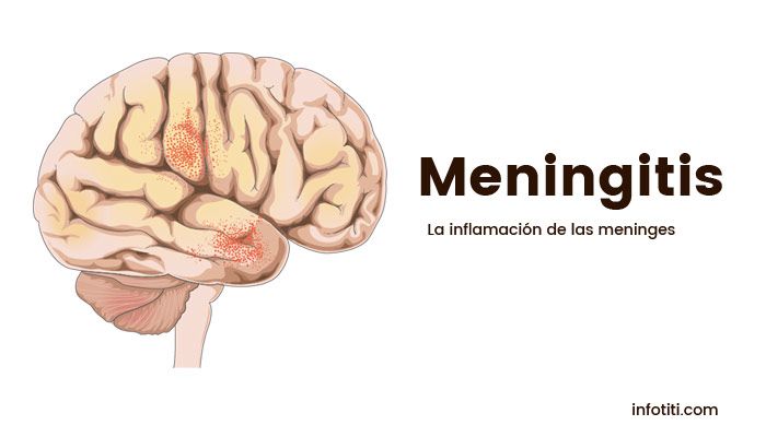 meningitis que es