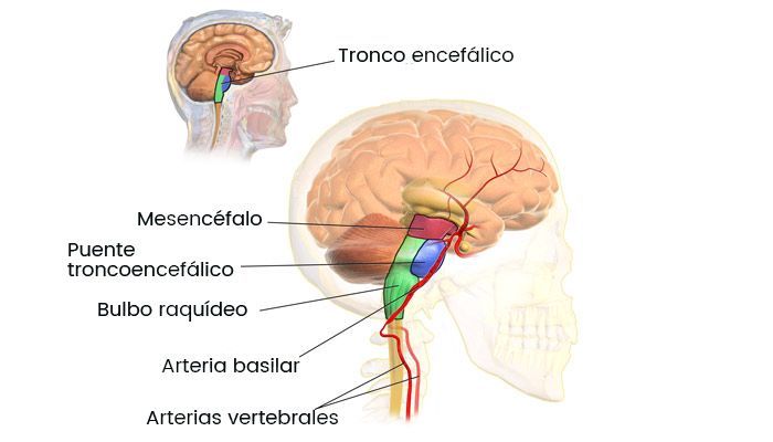 migraña basilar