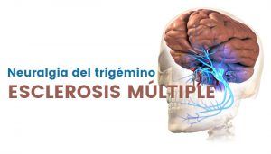 neuralgia del trigémino en la esclerosis múltiple