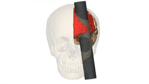 caso Phineas Gage