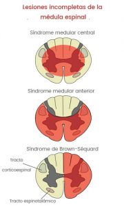 Síndromes medulares, ¿qué pasa si se lesiona la médula espinal?